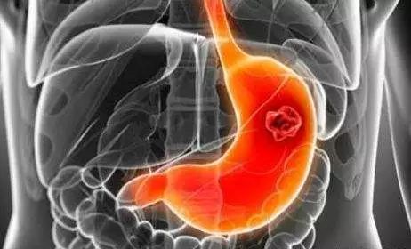 科普丨关于慢性胃炎最全的知识,想要胃病康复
